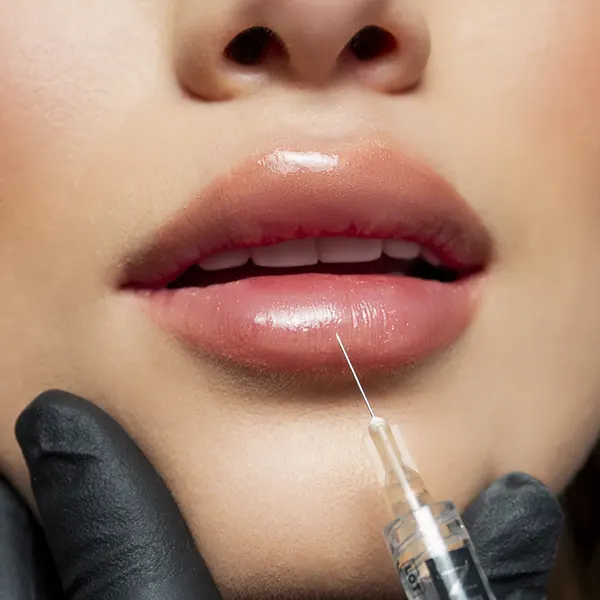 img-aumento-de-labios-bogota-1