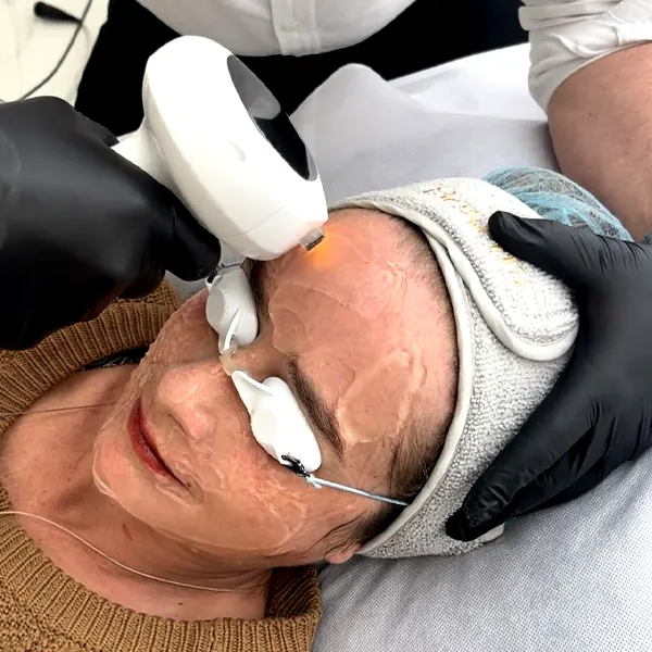 img-tratamiento-para-acne-bogota-1